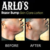 Arlo's Razor Bump Skin Care Lotion 6oz (PC)