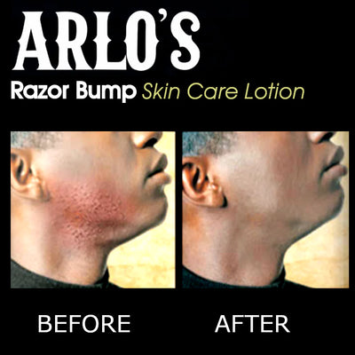 Arlo's Razor Bump Skin Care Lotion 6oz (PC)